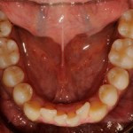 ortodonzia_linguale1_small