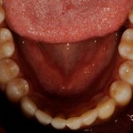 ortodonzia_linguale3_small