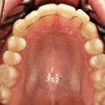 ortodonzia_linguale_retainer2_small