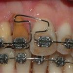 Ortodonzia Preprotesica